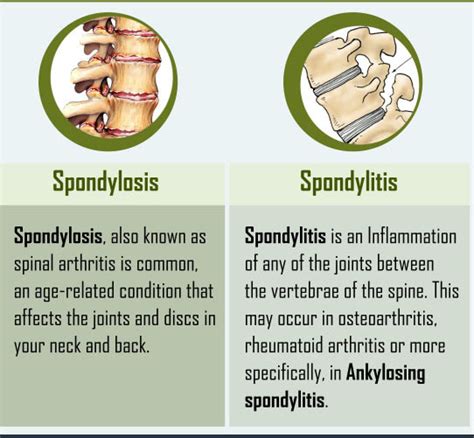 Spondylosis-Spondylitis – ReLiva Physiotherapy & Rehab