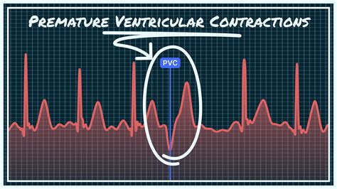 Premature Ventricular Contractions Pvcs Animation Premature Heart ...