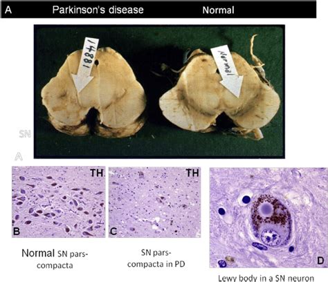 Substantia Nigra Histology