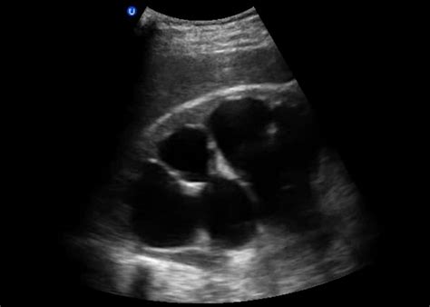 Renal Ultrasound — MMHEME