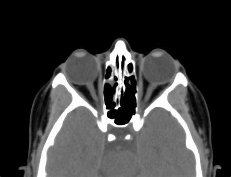 Ct Scan Of Eye Cost - appetitestory