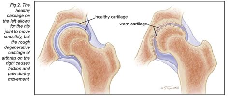 Arthritis of the Hip Joint - MU Health Care