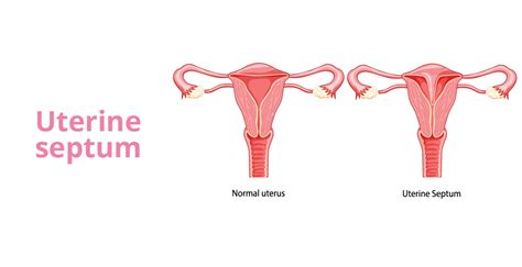 Uterine Septum: Symptoms & Treatment | Birla Fertility & IVF