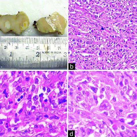 Cervical lymph node biopsy showing effacement of architecture, replaced ...