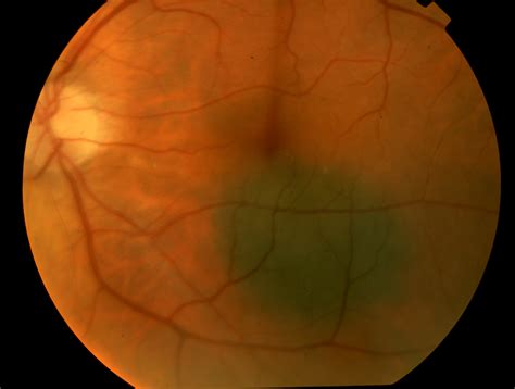 Choroidal Nevus | Retina Consultants of Nevada |Retina Doctor Las Vegas - Retina Consultants of ...