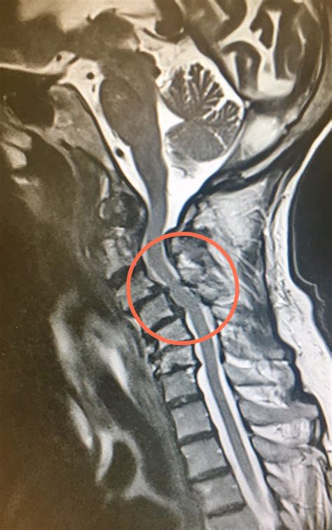 Myelopathy - Spines Dorset