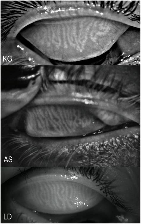 Lid Meibography Images | OCULUS Surgical | Bioz