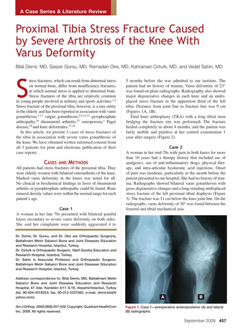 (PDF) Proximal tibia stress fracture caused by severe arthrosis of the knee with varus deformity