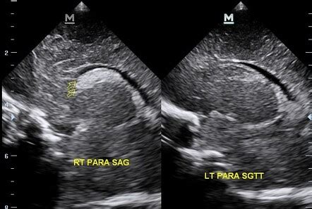 Grade 1 germinal matrix hemorrhage | Radiology Case | Radiopaedia.org