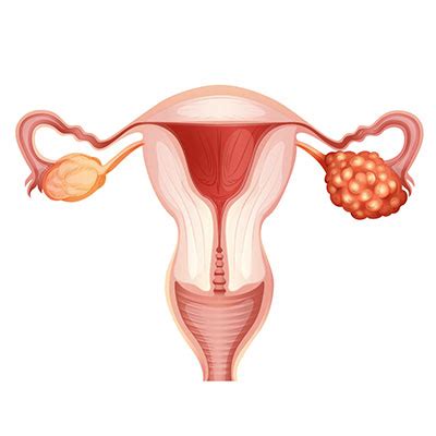 Affordable Ovarian Cancer Treatment In Bangkok | Vejthani