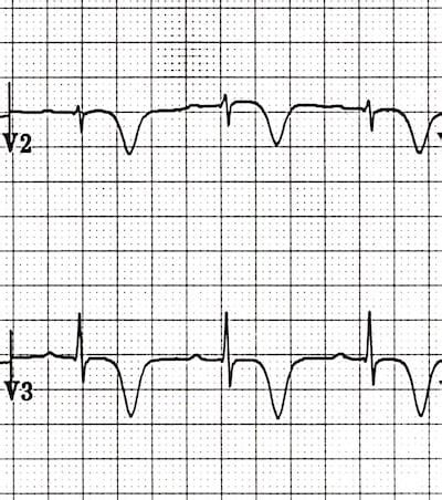 Wellens Syndrome • LITFL • ECG Library Eponym