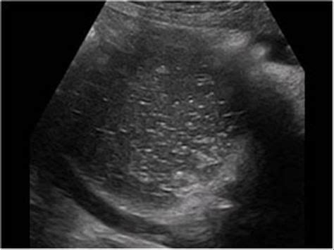 Case of the month January 2009: Dermoid cysts / cystic teratomas | Dermoid cyst, Ultrasound ...