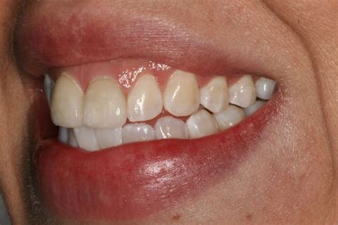 "White Spots", mottled tooth enamel - Cosmetic Dentistry - Before and After Gallery