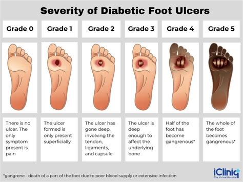 Year Old Man Diabetic Foot Ulcer Wagner Classification Grade A | My XXX ...