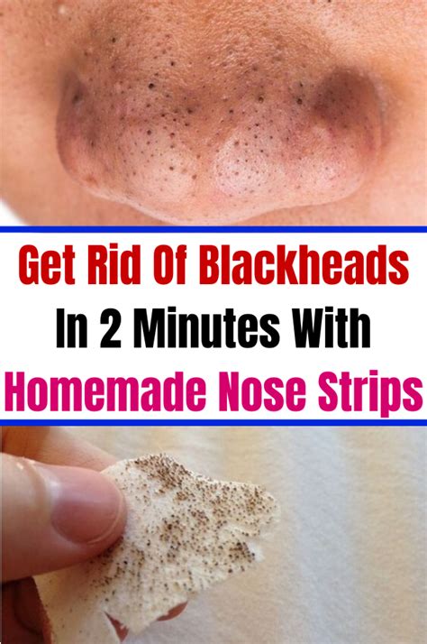 Get Rid Of Blackheads In 2 Minutes With Homemade Nose Strips ...