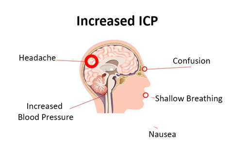 Increased Intracranial Pressure: A Guide For Nurses | Ausmed