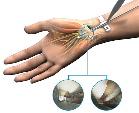 Endoscopic Carpal Tunnel Release (ECTR) | Trice Medical