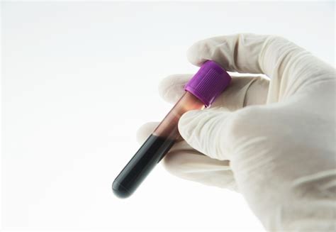 √70以上 edta blood test full form 198248-What is edta blood test