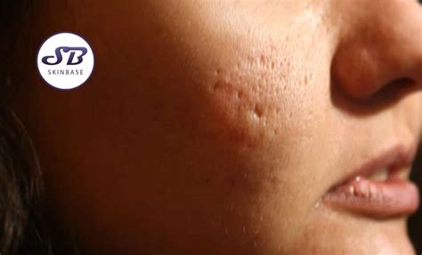 Can microdermabrasion help acne scars?