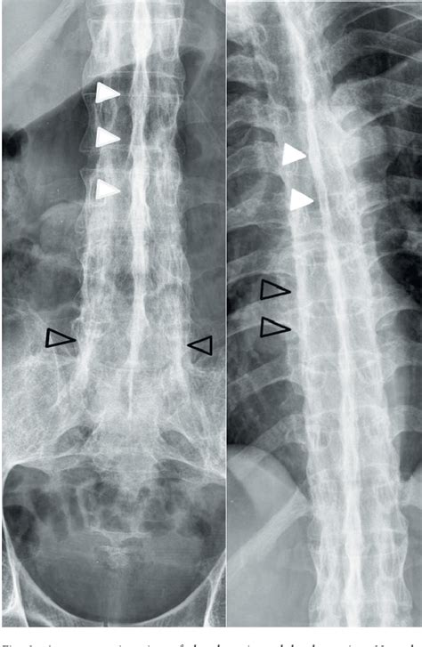 Figure 3 from Bamboo spine – X-ray findings of ankylosing spondylitis revisited | Semantic Scholar