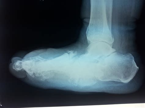 Charcot Foot Reconstruction 1 - Foot Doctor San Diego / La Jolla Podiatrist