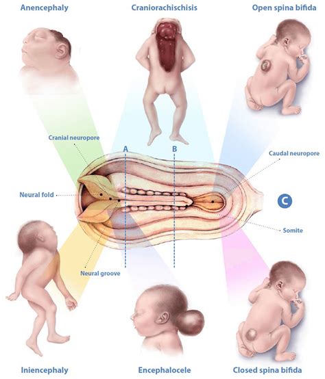 What Is Spina Bifida? - StoryMD