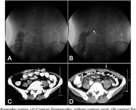 Figure 1 from Management of a Patient with Colocutaneous Fistula by ...