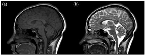 Imaging findings of two patients with isolated infarction of the splenium during COVID-19 ...