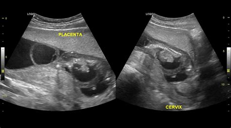 Ultrasound 101(Hydrops fetalis) : r/Radiology