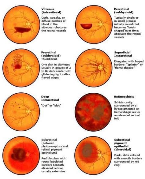 HEMORRHAGE IN RETINA - New