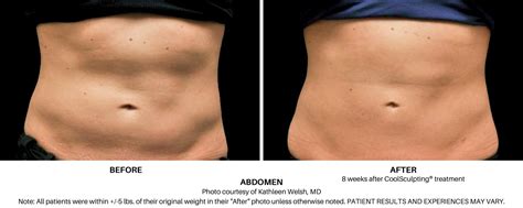 CoolSculpting for Stomach in Fulton, Maryland — Rejuvenate Wellness & MedSpa