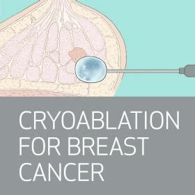 Cryoablation for Breast Cancer | Houston Methodist