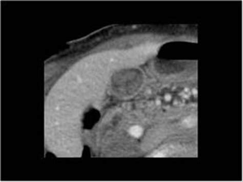 Abdomen and retroperitoneum | 1.2 Gallbladder and bile ducts : Case 1.2.2 Gallbladder: Thickened ...