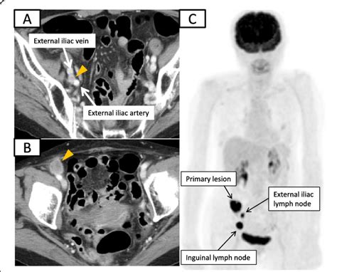 Internal Iliac Lymph Nodes