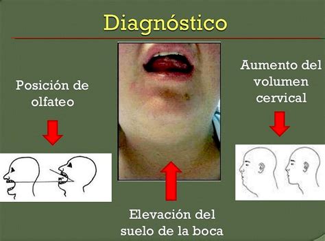 ANGINA DE LUDWIG ETIOLOGIA PDF