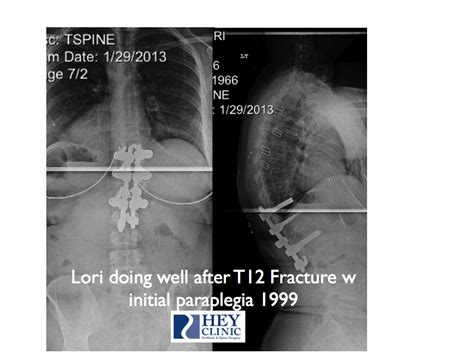 Lori, Almost 14 years after T12 Burst Fracture I fixed Easter 1999 shows up doing well - Hey Clinic