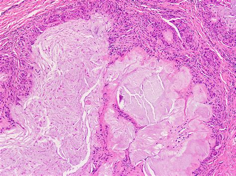 Tophus Histology