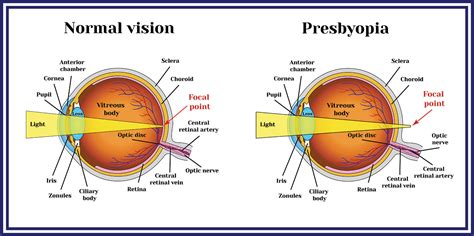 Presbyopia - Azar Eye Clinic