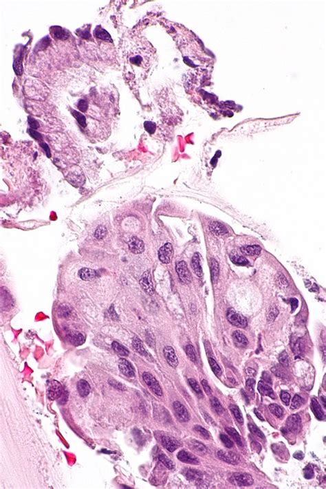 Squamous metaplasia of the uterine cervix - Libre Pathology