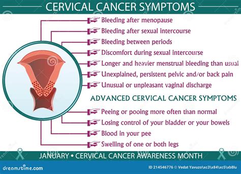 Cervical Cancer Symptoms Infographic Vector Illustration | CartoonDealer.com #214546776