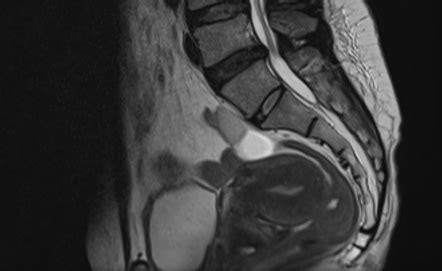 Anteverted retroflexed uterus | Radiology Case | Radiopaedia.org