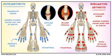 Osteoarthritis vs. Rheumatoid Arthritis | Medcomic