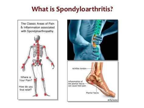 Pin on EDS, Fibromyalgia, Hashimoto, Arthritis, Osteoporosis and more and more