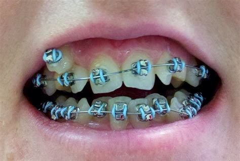 I love the color of the bands | Braces colors, Teeth braces, Cute braces