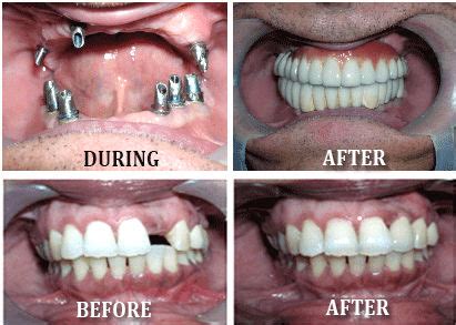 Dental Implants – Richardson's Plastic Surgery Hospitals