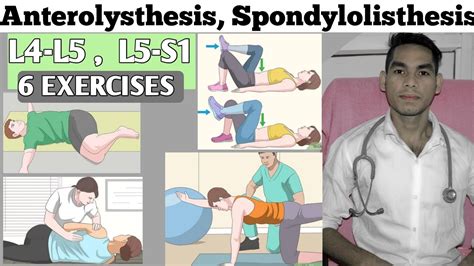 Anterolisthesis spondylolisthesis l4 L5-s1 exercise treatment, Low back ...