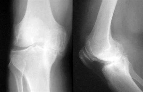 Radiological Degenerative Joint Disease (Osteoarthritis) of the Knee | Arthritis Research and ...