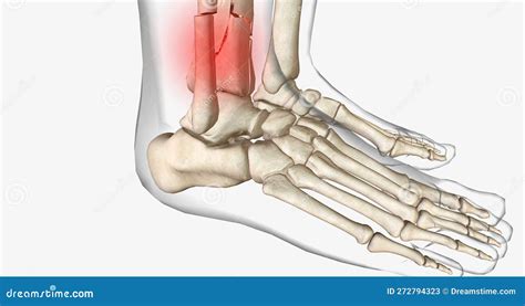 Distal Tibia Fractures Affect the Ankle Joint and Can Often Involve a Fracture of the Fibula ...