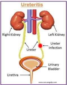 Ureteritis: Causes, Symptoms, Management - We Care