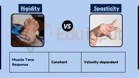 Difference Between Rigidity and Spasticity